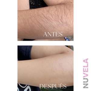 DEPILADORA LASER IPL PROFESIONAL